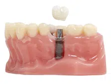implant