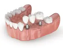 multiple-tooth-replacement